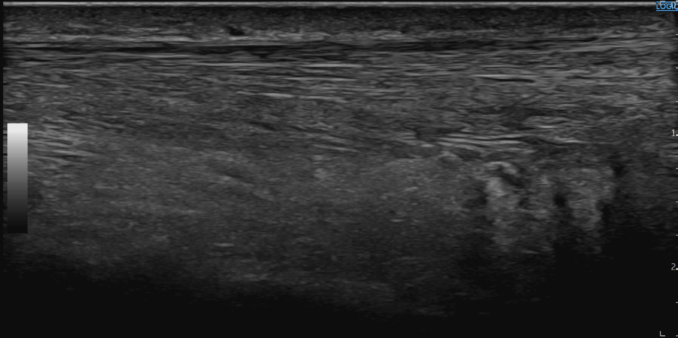 Partial Tear / Tendinopathy Achilles Tendon | SonoTool®